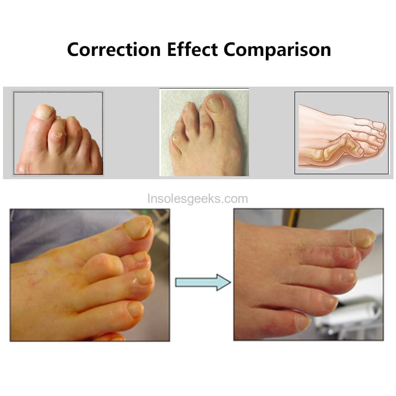 Foot Splint Straightener Toes Bunion Corrector for Right Left